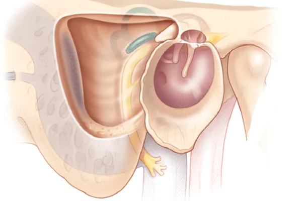 Mastoidectomy