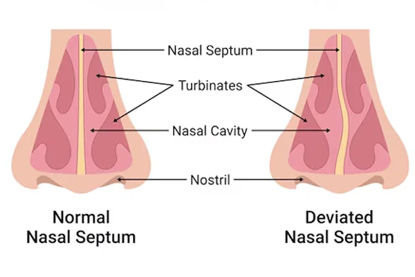 Deviated Nasal Septum Treatment