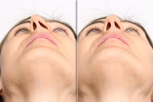 Septoplasty