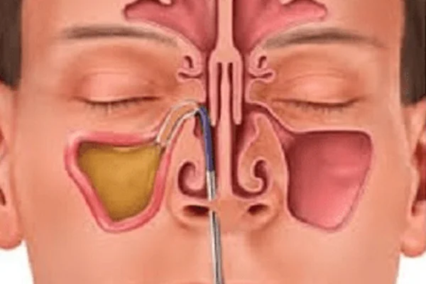 Balloon Sinoplasty