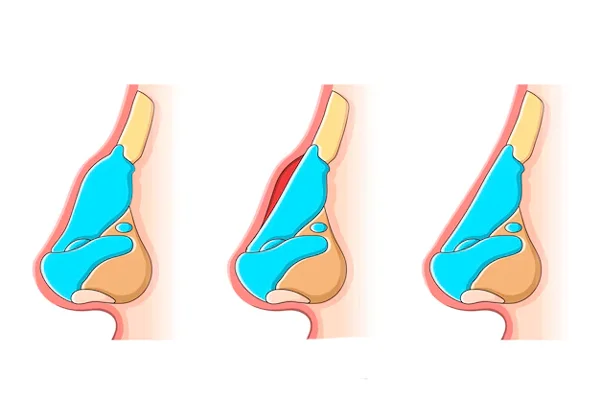 Rhinoplasty