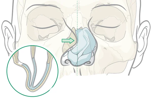 Fracture Nasal Bone Treatment