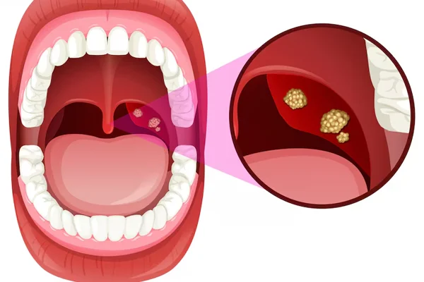 Tonsillitis Treatment
