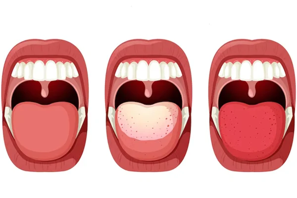 Pharyngolaryngitis Treatment