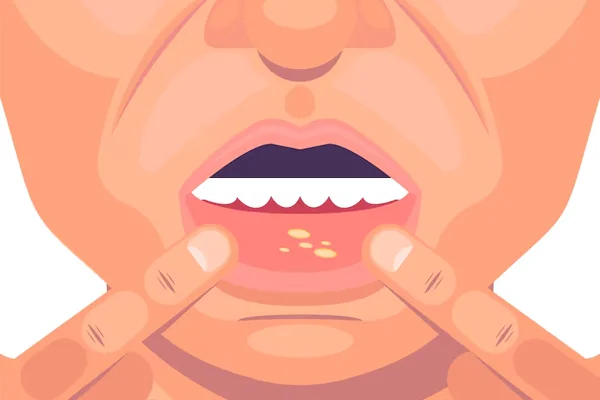 Oral Ulcers Management