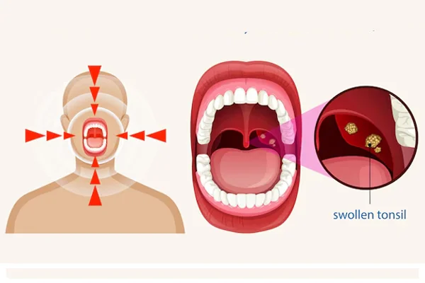 Tonsillectomy
