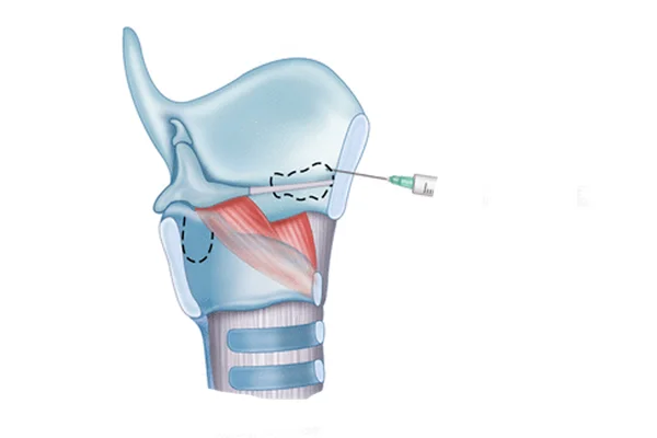Injection Laryngoplasty