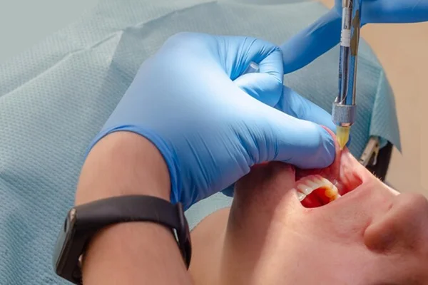 Vallecular Cyst Excision