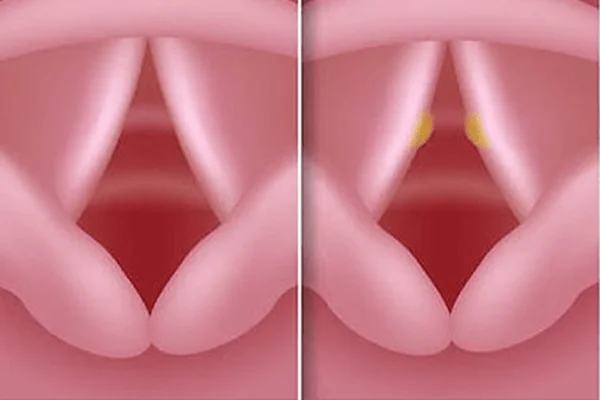 Vocal Nodule Management