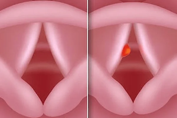 Vocal Polyp Management
