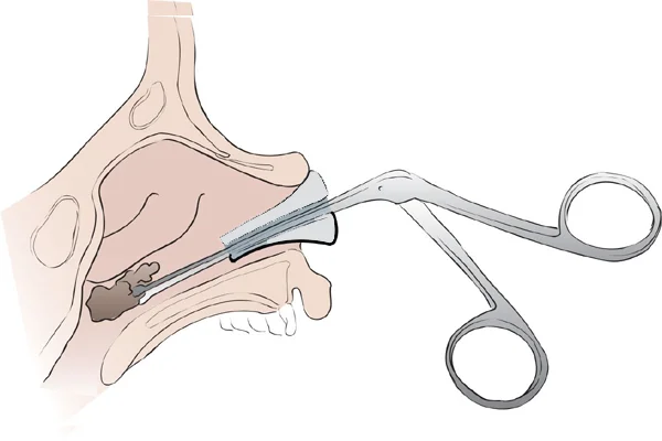 Foreign Body Nose Removal