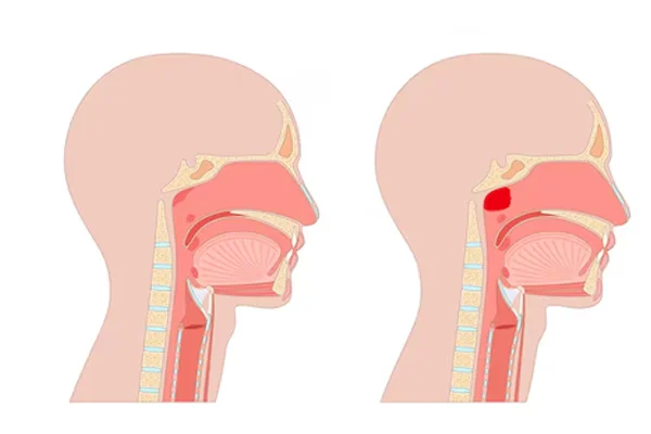 Adenoid Enlargement Management