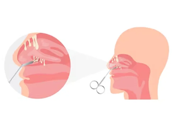 Nasal Mass Treatment