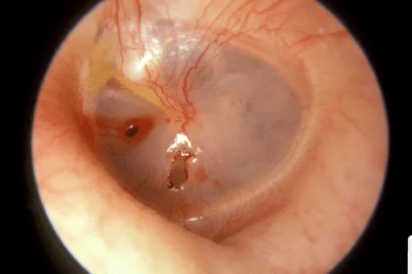 Traumatic Ear Perforation Treatment