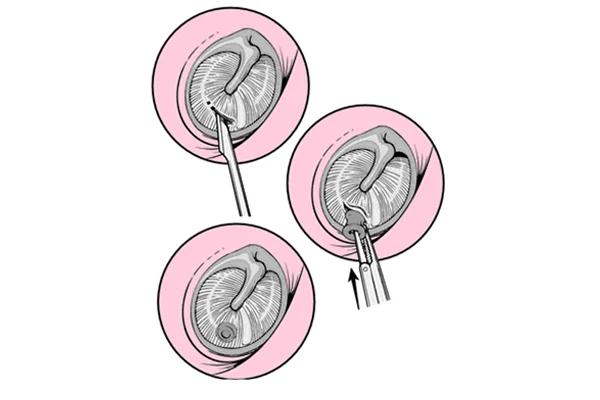 Myringotomy