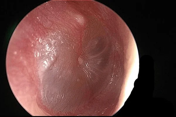 Middle Ear Infection Management